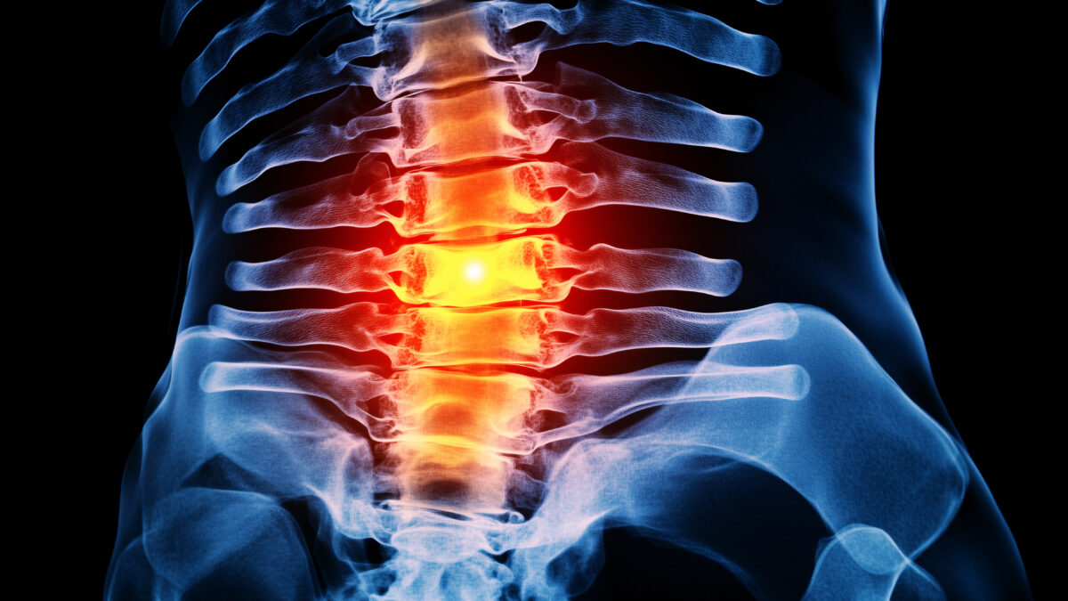 X-ray of a spine with red coloring on the spine indicating flaring pain