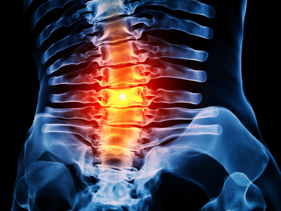 X-ray of a spine with red coloring on the spine indicating flaring pain